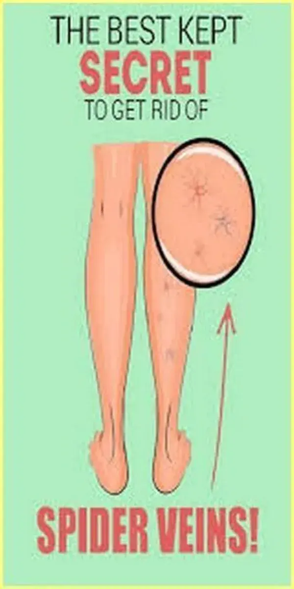 3 Natural Ways To Get Rid Of Spider Veins