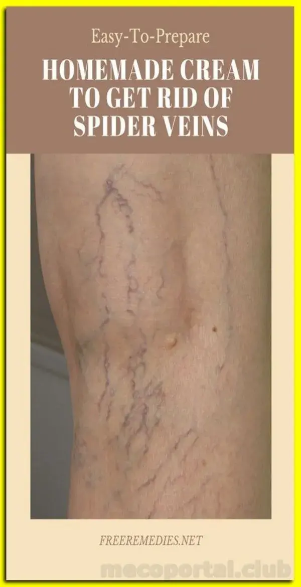 3 NATURAL WAYS TO GET RID OF SPIDER VEINS