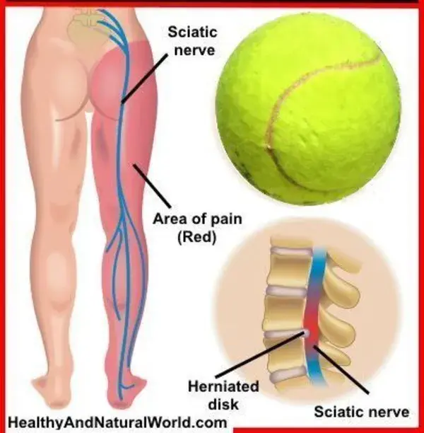 How To Relieve Sciatic Nerve Pain And Back Pain With Just a Tennis Ball