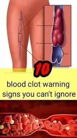 10 blood clot warning signs you can’t ignore