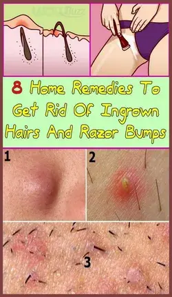 Great Trick With Which You Will No Longer Have Ingrown Hairs After Shaving