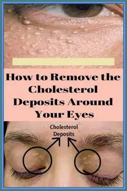 7 Remedies To Get Rid Of Cholesterol Milk Spots Naturally