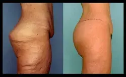 Body lift Miami - Dr. Ramirez Plastic Surgeon
