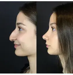 Rhinoplasty Before and after