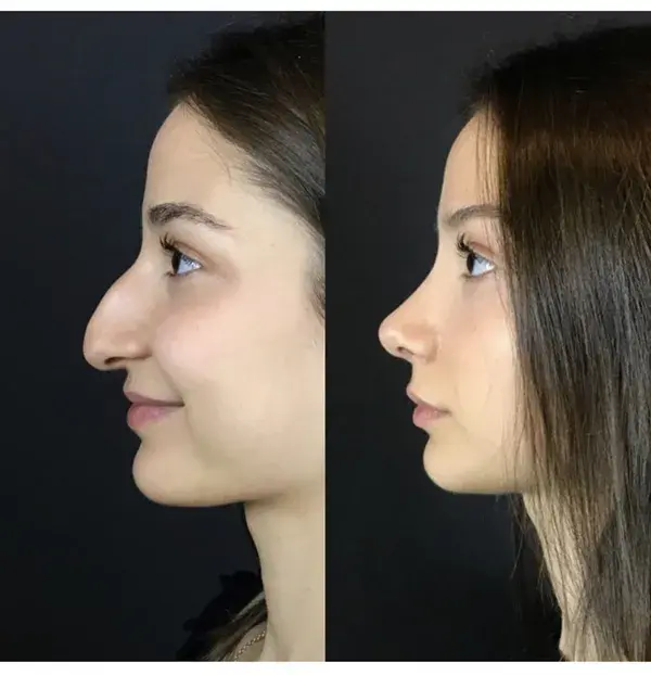 Rhinoplasty Before and after