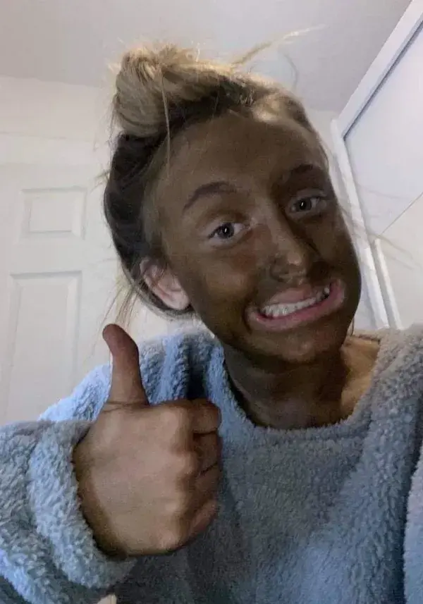 Girl, 13, left looking like an Oompa-Loompa after mistakenly using ultra-dark fake tan