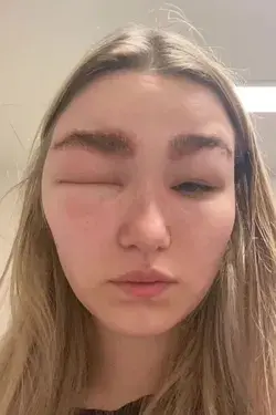 Woman suffers brutal allergic reaction after getting her eyebrows laminated and a week in it’s only getting WORSE