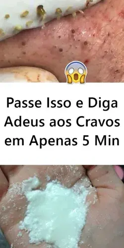 Passe Isso e Diga Adeus aos Cravos em Apenas 5 Minutos