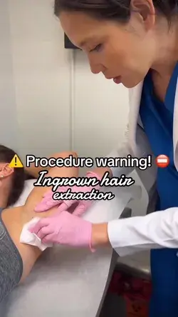 Ingrown hair extraction-Skincare procedures #dermatologist