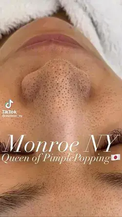 Blackheads popping