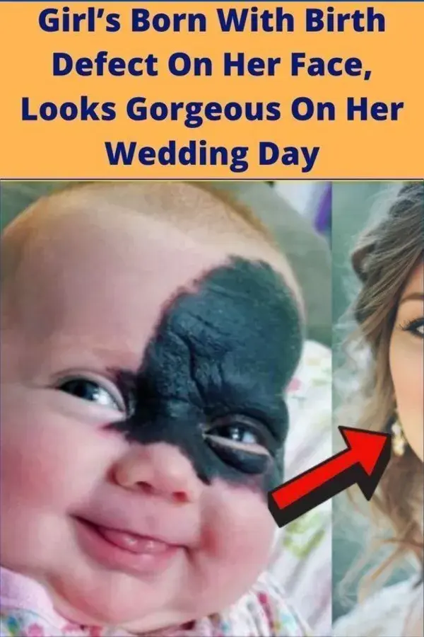 Girl’s Born With Birth Defect On Her Face, Looks Gorgeous On Her Wedding Day