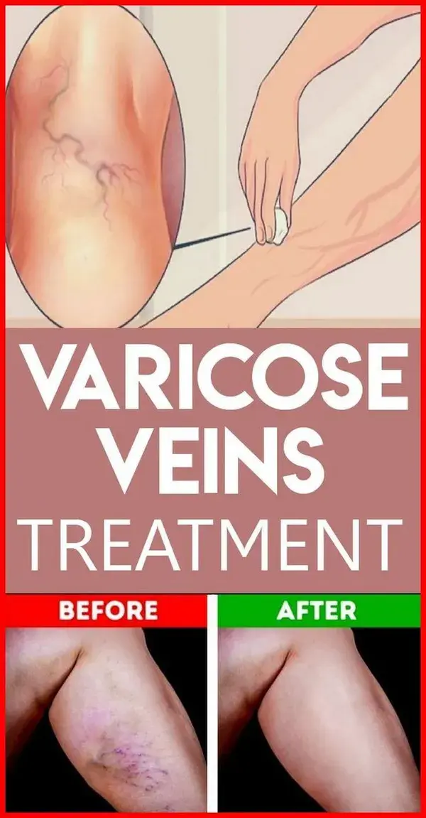 This Natural Ingredient Will Help You Get Rid Of Varicose Veins In Just 3 Days !