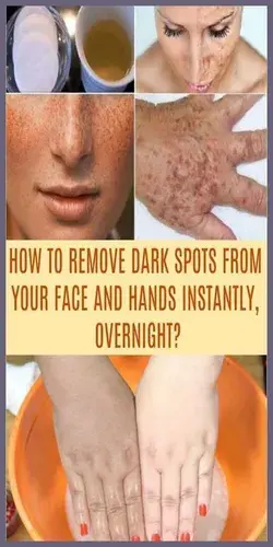 How To Get Rid of Pigmentation And Dark Spots Naturally