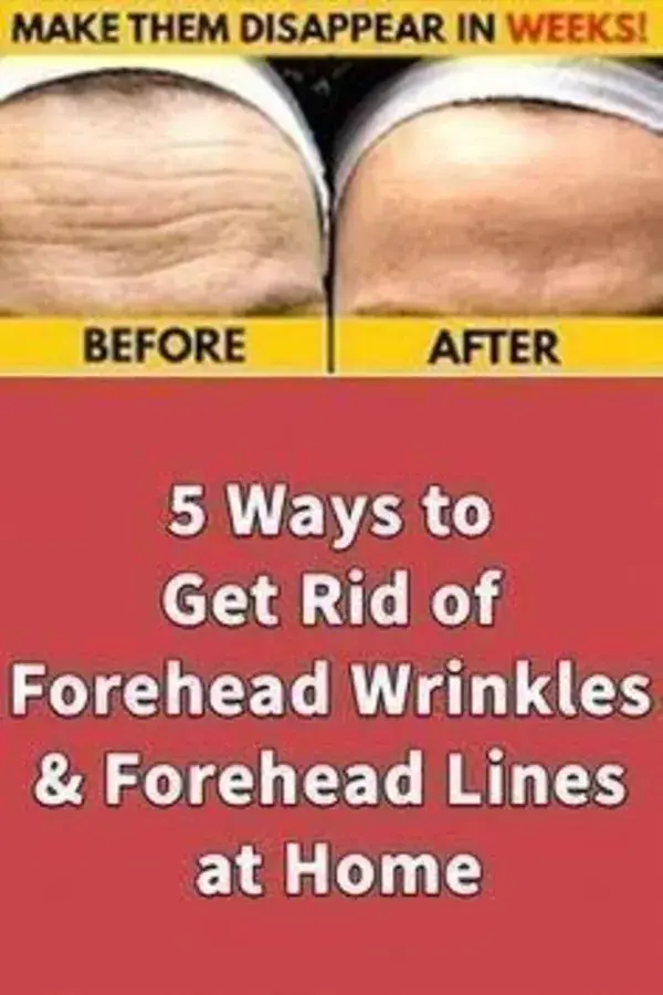 5 ways to get rid of forehead wrinkles and forehead lines at home