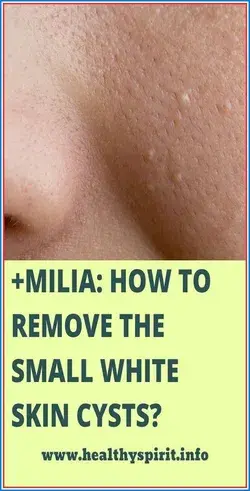 MILIA: HOW TO REMOVE THE SMALL WHITE SKIN CYSTS?