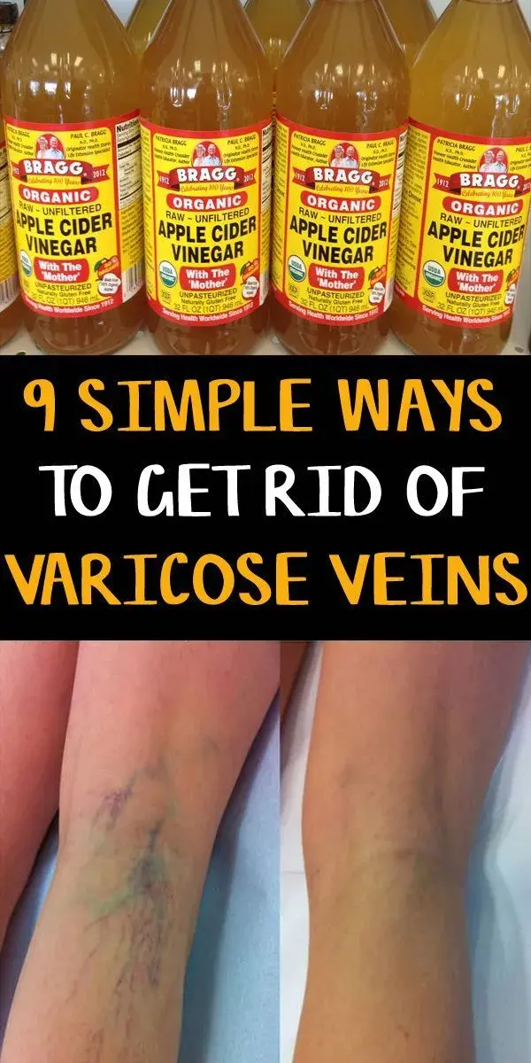 How To Get Rid of Varicose Veins Naturally at Home | DIY Health Tips