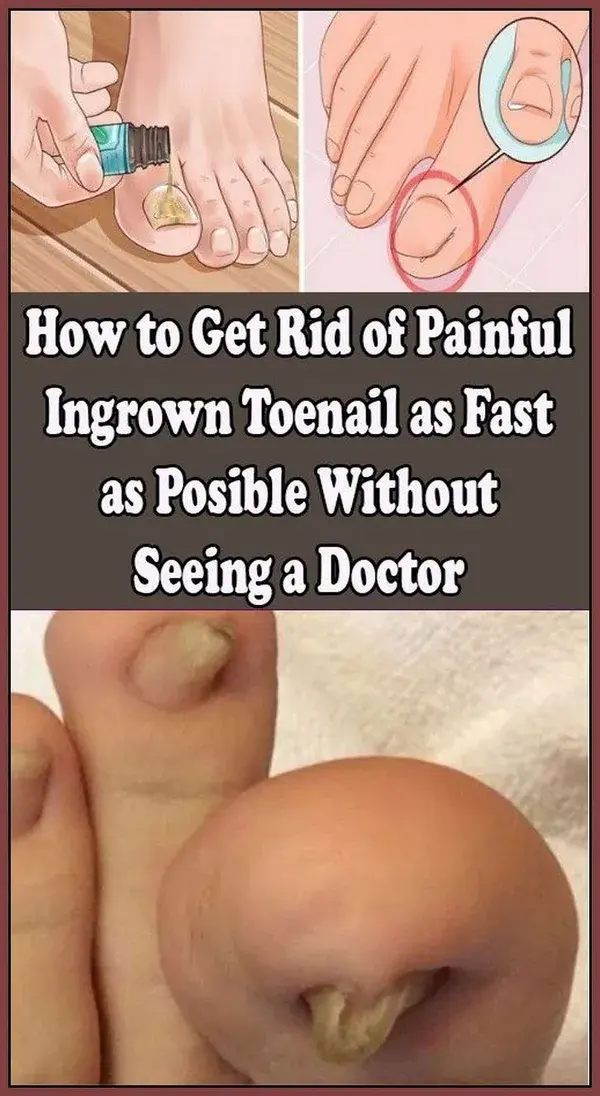 How To Get Rid Of A Painful Ingrain Nail Without a Doctor