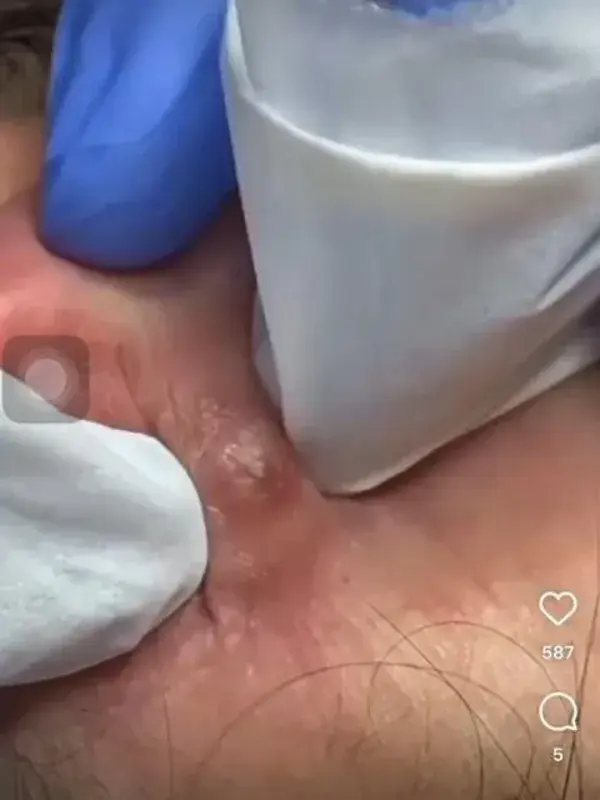 Big pimple squeeze satisfying