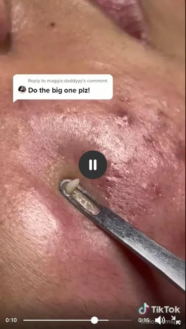 Blackheads extraction removal