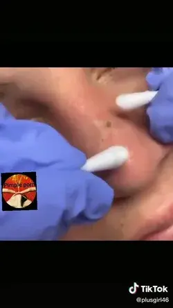 Blackheads removal so satisfying