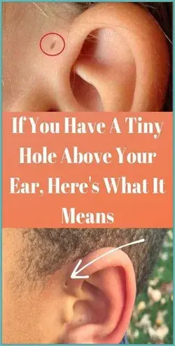 If You Have A Tiny Hole Above Your Ear, Here?s What It Means