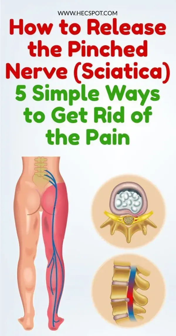 How to Release the Pinched Nerve in the Lumbar Area (sciatica)