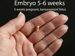 Embryo 5-6 weeks, 5 weeks pregnant