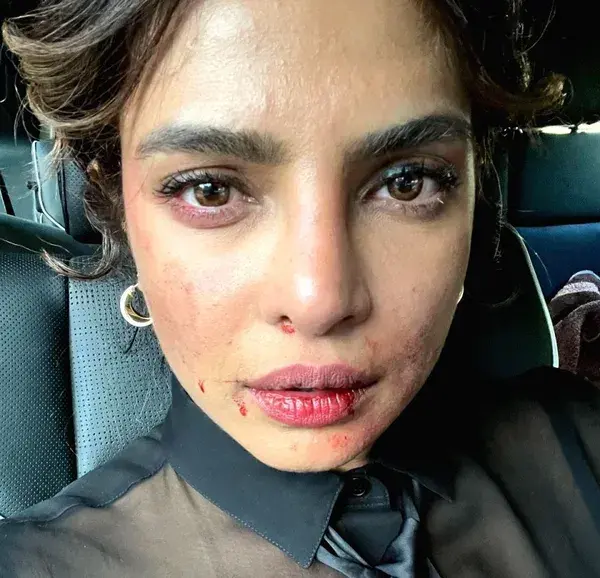 Priyanka Chopra shares picture of 'bruised' face from 'Citadel' set