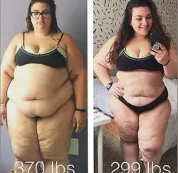 Weight loss without Surgery