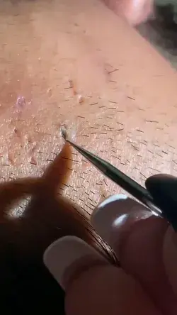 Blackheads extraction satisfying