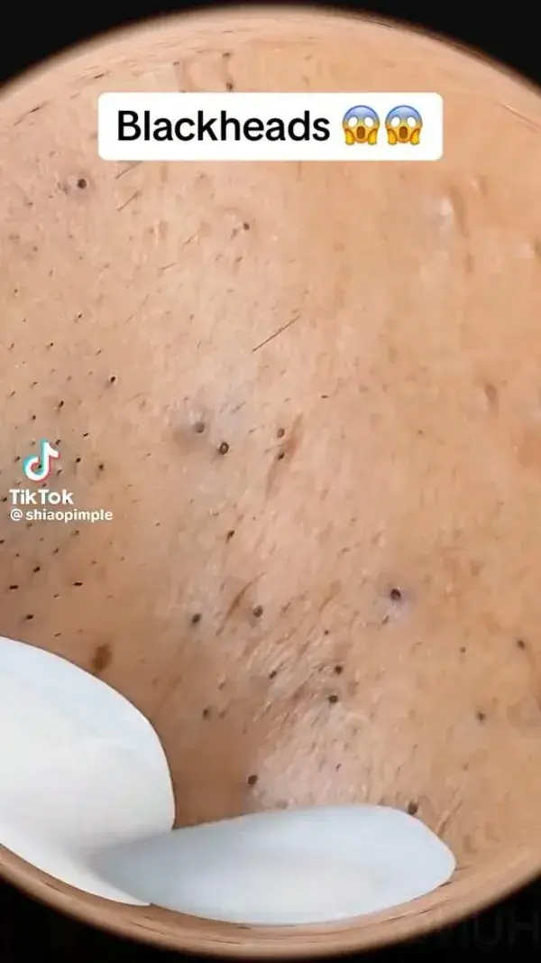 Blackheads extraction video