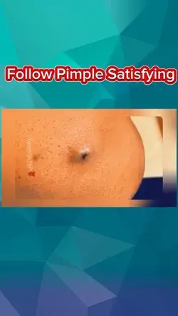 Big pimple blackhead removal