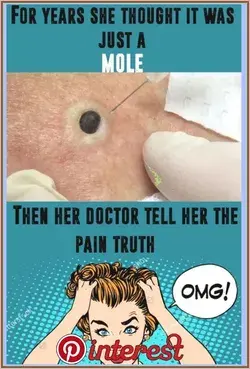 FOR YEARS SHE THOUGHT THAT IT WAS JUST A MOLE. HER DOCTOR TOLD THAT IT ISN’T. WHAT SHE YANKS OUT?