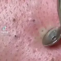 Blackheads removal