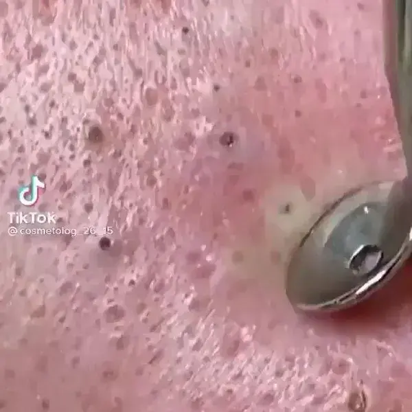 Blackheads removal