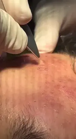 blackheads