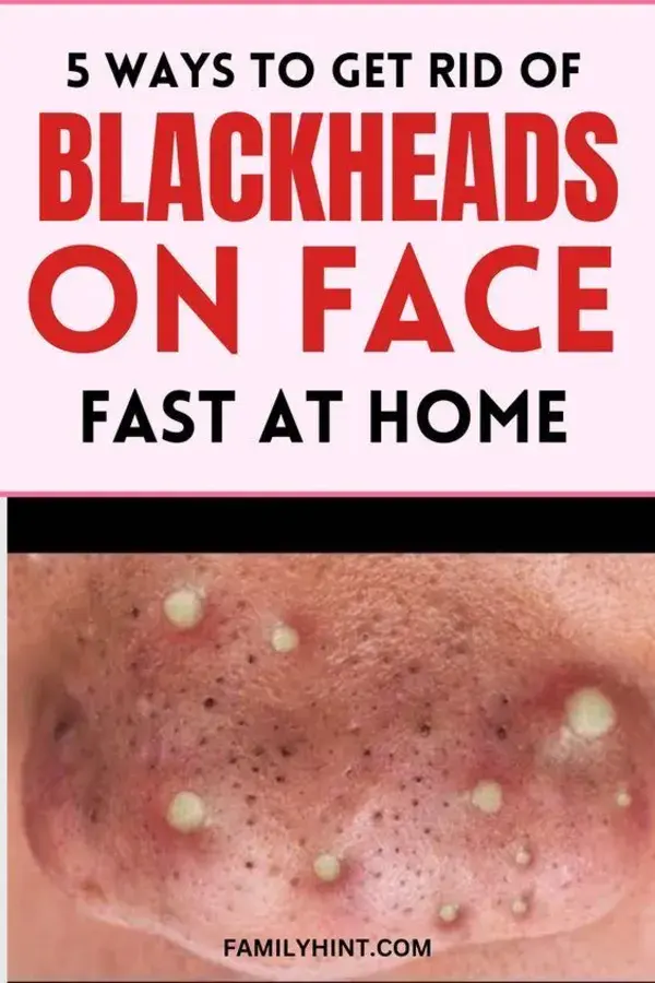 5 Ways To Get Rid Of Blackheads On Face Fast At Home