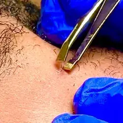 Ingrown Hair Extraction | Atlanta
