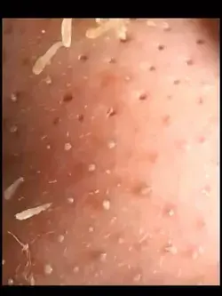 blackhead ～ #blackheads #blackhead #pimple #asmr #acne #satisfying #foryou