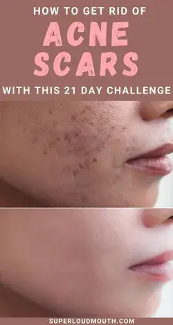 How to get rid of Acne scars with this 21 day challenge