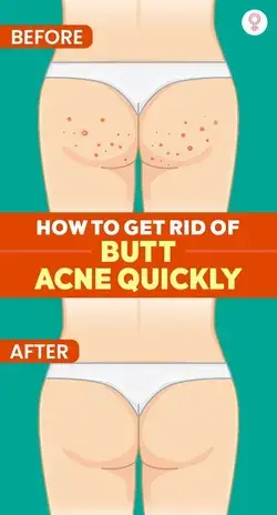 How To Get Rid Of Butt Acne Quickly