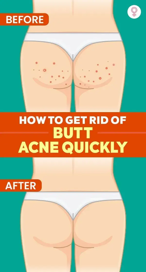 How To Get Rid Of Butt Acne Quickly