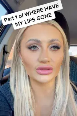 I finally decided to get my lip fillers dissolved after six years – I was nervous but people say I look much younger