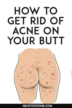 How to Get Rid of Pimples on Your Back