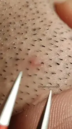 satisfying ingrown hair removal