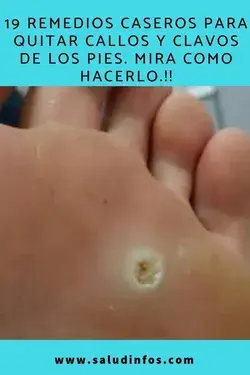 ¿Cómo curar los hongos delas uñas con vinagre y bicarbonato?