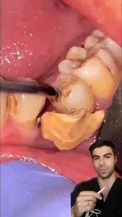 Huge tartar removal