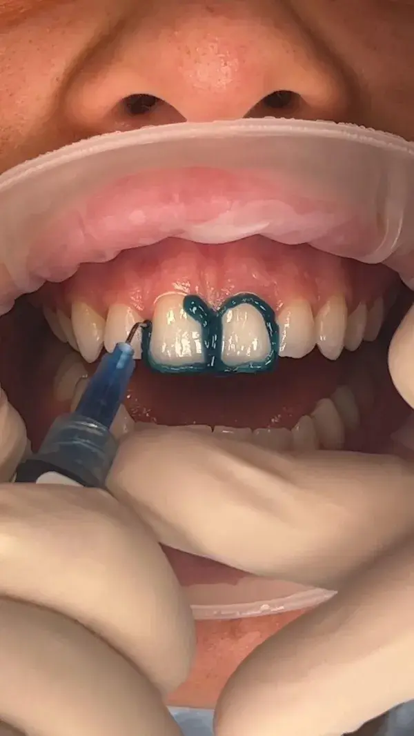 Composite veneers - Kissdental