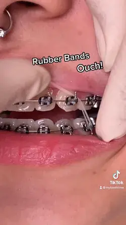 Braces Rubber bands!