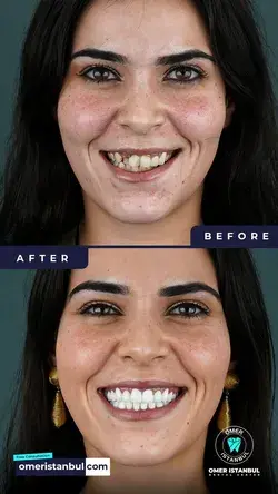 Zirconia Crown Teeth Treatment - Before After - Omer Istanbul Dental Center